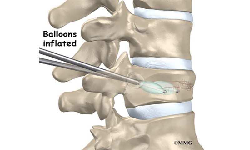 Kyphoplasty