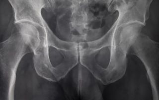 Pelvic Congestion Syndrome