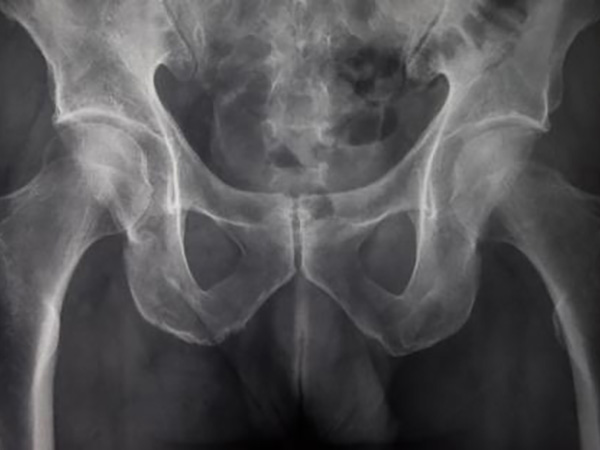 Pelvic congestion syndrome, Radiology Reference Article
