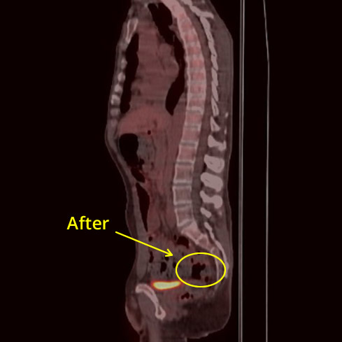 Colon Cancer After Picture