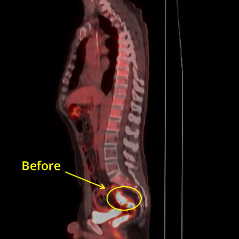 Colon Cancer Before Picture