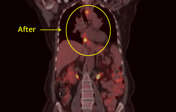 Esophageal Cancer After Picture