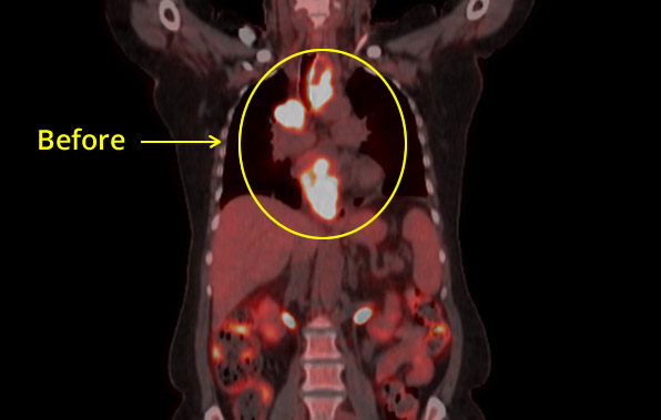 Esophageal Cancer Before Picture