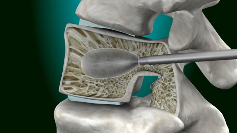 Kyphoplasty Procedure for Spine Fractures