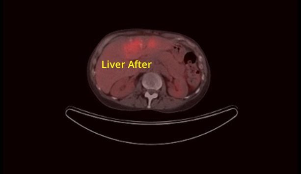 Liver Cancer After Picture