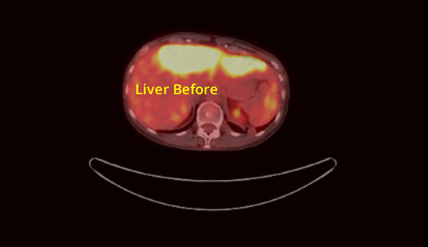 Liver Cancer Before Picture